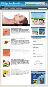 Vitiligo Niche Blog Personal Use Template With Video