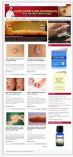Moles Warts Niche Blog PLR Template